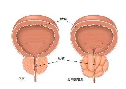 “前腺”不防守，后方被破门！ 造成前列腺增生的……(图1)